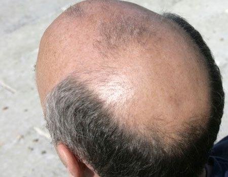 Какие услуги предлагает клиника по пересадке волос